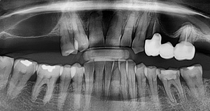 상악동거상술 증례1 Before